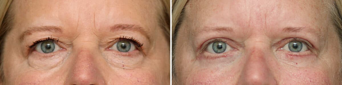 Lower Eyelid Surgery Before and After Photos in Princeton, NJ, Patient 3708