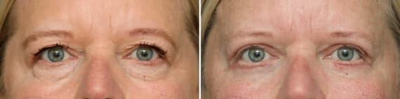 Lower Eyelid Surgery Before and After Photos in Princeton, NJ, Patient 3708