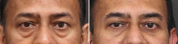 Lower Eyelid Surgery Before and After Photos in Princeton, NJ, Patient 3709