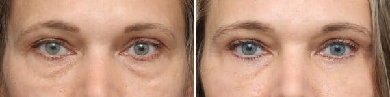 Upper Eyelid Surgery Before and After Photos in Princeton, NJ, Patient 3737