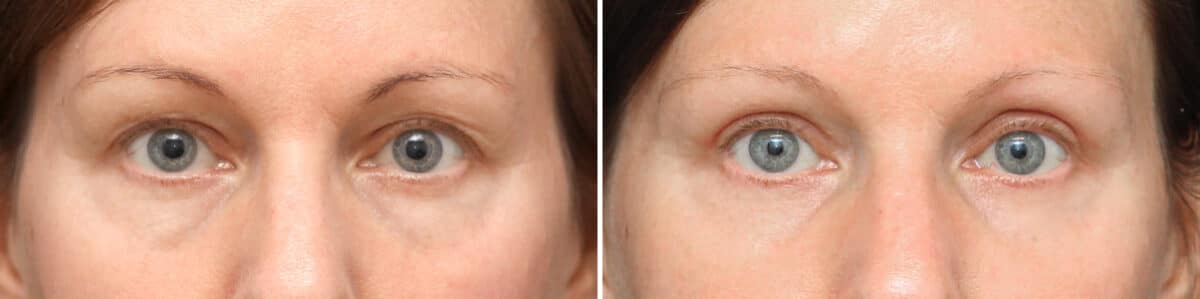 Upper Eyelid Surgery Before and After Photos in Princeton, NJ, Patient 3738