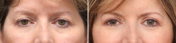 Upper Eyelid Surgery Before and After Photos in Princeton, NJ, Patient 3740