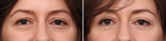 Upper Eyelid Surgery Before and After Photos in Princeton, NJ, Patient 3741