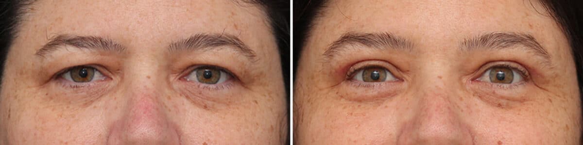 Upper Eyelid Surgery Before and After Photos in Princeton, NJ, Patient 3742