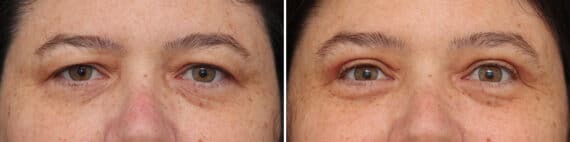 Upper Eyelid Surgery Before and After Photos in Princeton, NJ, Patient 3742