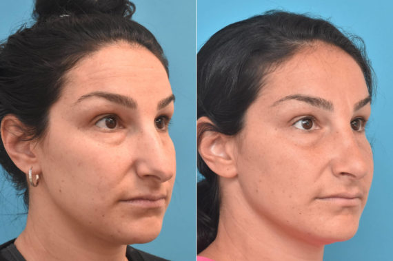 Rhinoplasty Before and After Photos in Philadelphia, PA, Patient 3761