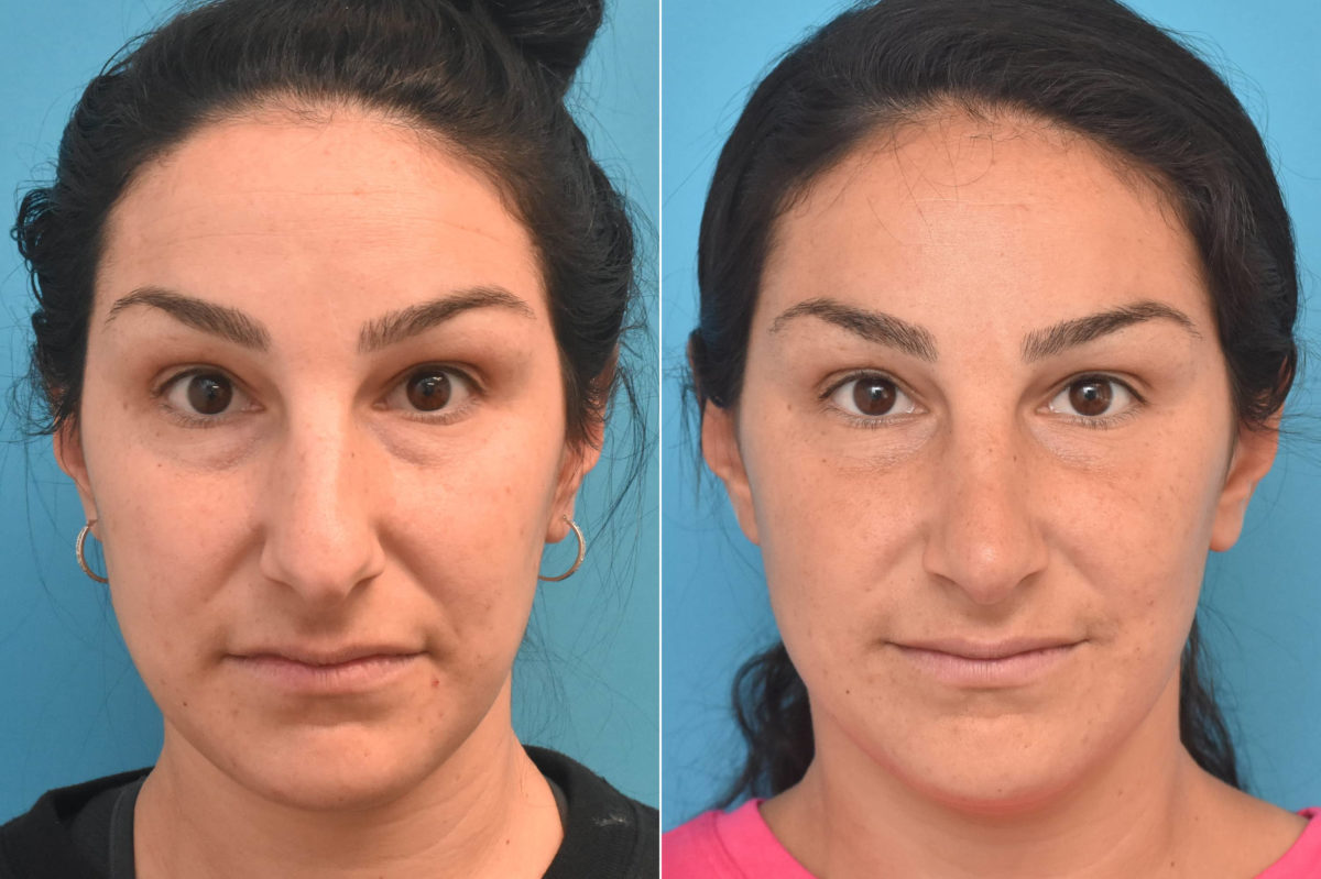 Rhinoplasty Before and After Photos in Philadelphia, PA, Patient 3761