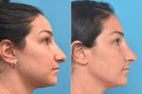 Rhinoplasty Before and After Photos in Philadelphia, PA, Patient 3761