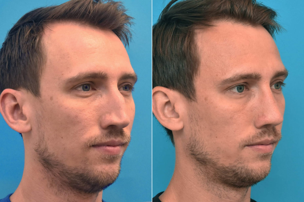 Rhinoplasty Before and After Photos in Philadelphia, PA, Patient 3762