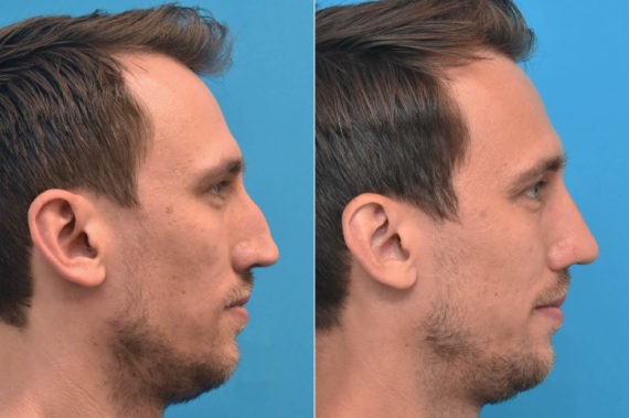 Rhinoplasty Before and After Photos in Philadelphia, PA, Patient 3762