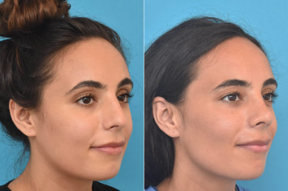 Rhinoplasty Before and After Photos in Philadelphia, PA, Patient 3763