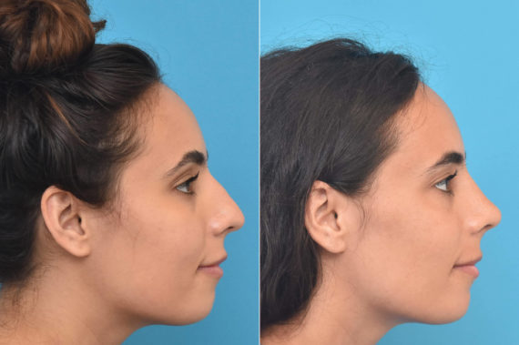 Rhinoplasty Before and After Photos in Philadelphia, PA, Patient 3763