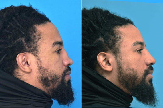 Rhinoplasty Before and After Photos in Philadelphia, PA, Patient 3764