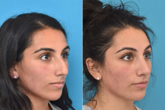 Rhinoplasty Before and After Photos in Philadelphia, PA, Patient 3765