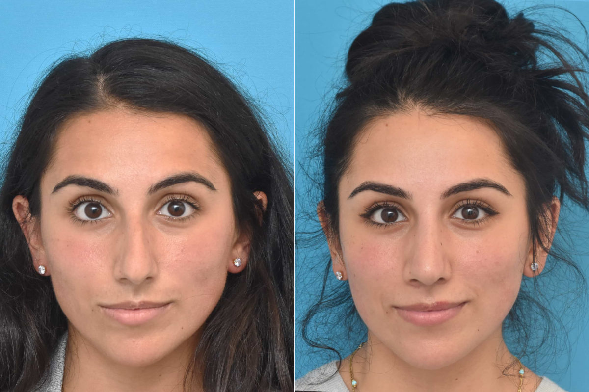 Rhinoplasty Before and After Photos in Philadelphia, PA, Patient 3765