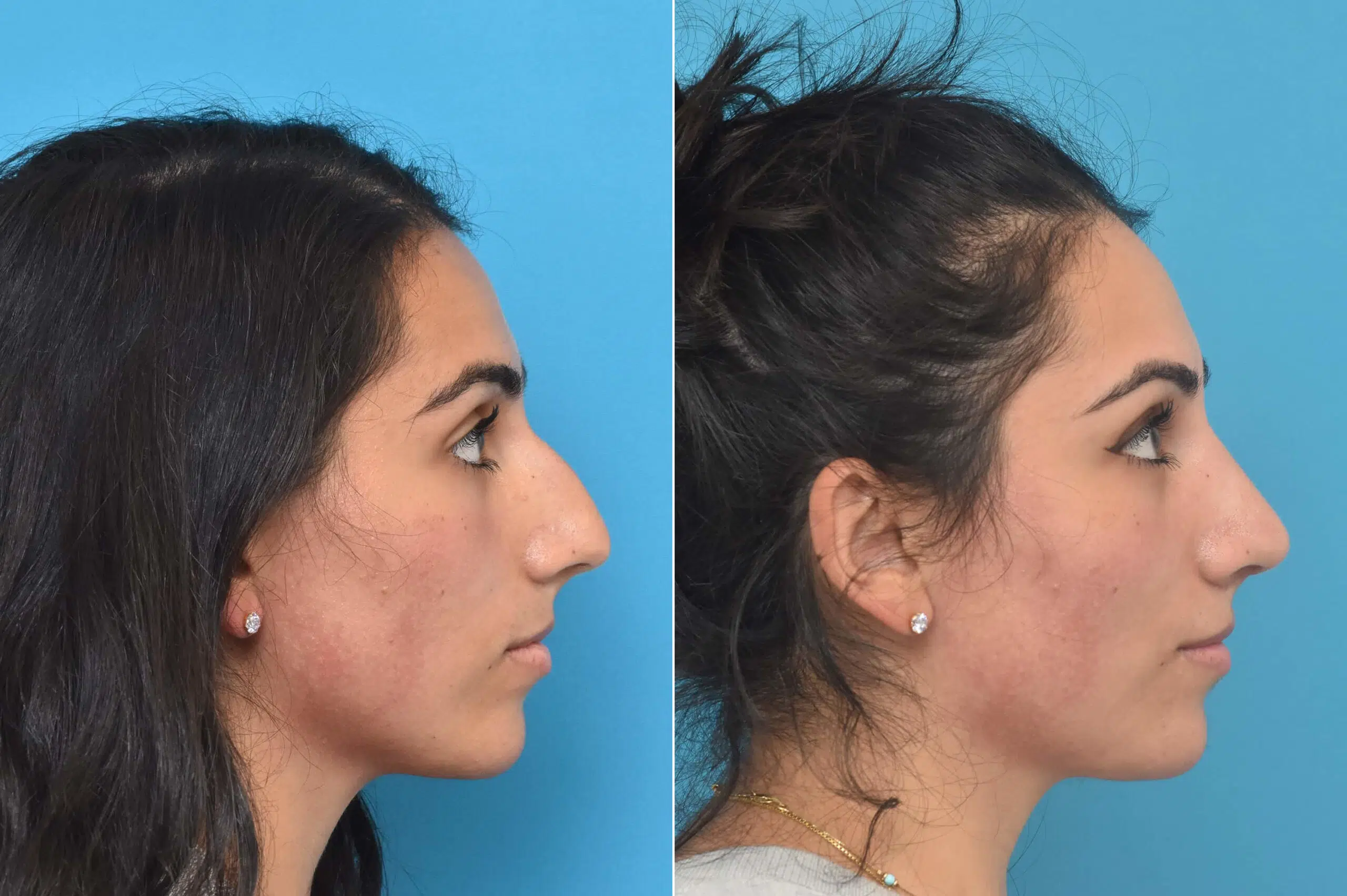 Rhinoplasty before & after photo patient