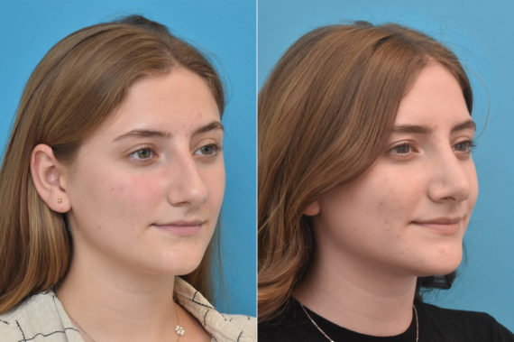 Rhinoplasty Before and After Photos in Philadelphia, PA, Patient 3766