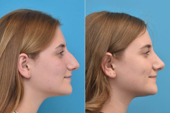 Rhinoplasty Before and After Photos in Philadelphia, PA, Patient 3766