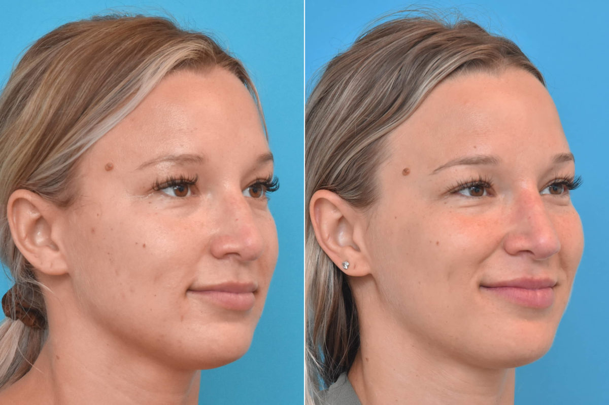 Rhinoplasty Before and After Photos in Philadelphia, PA, Patient 3767