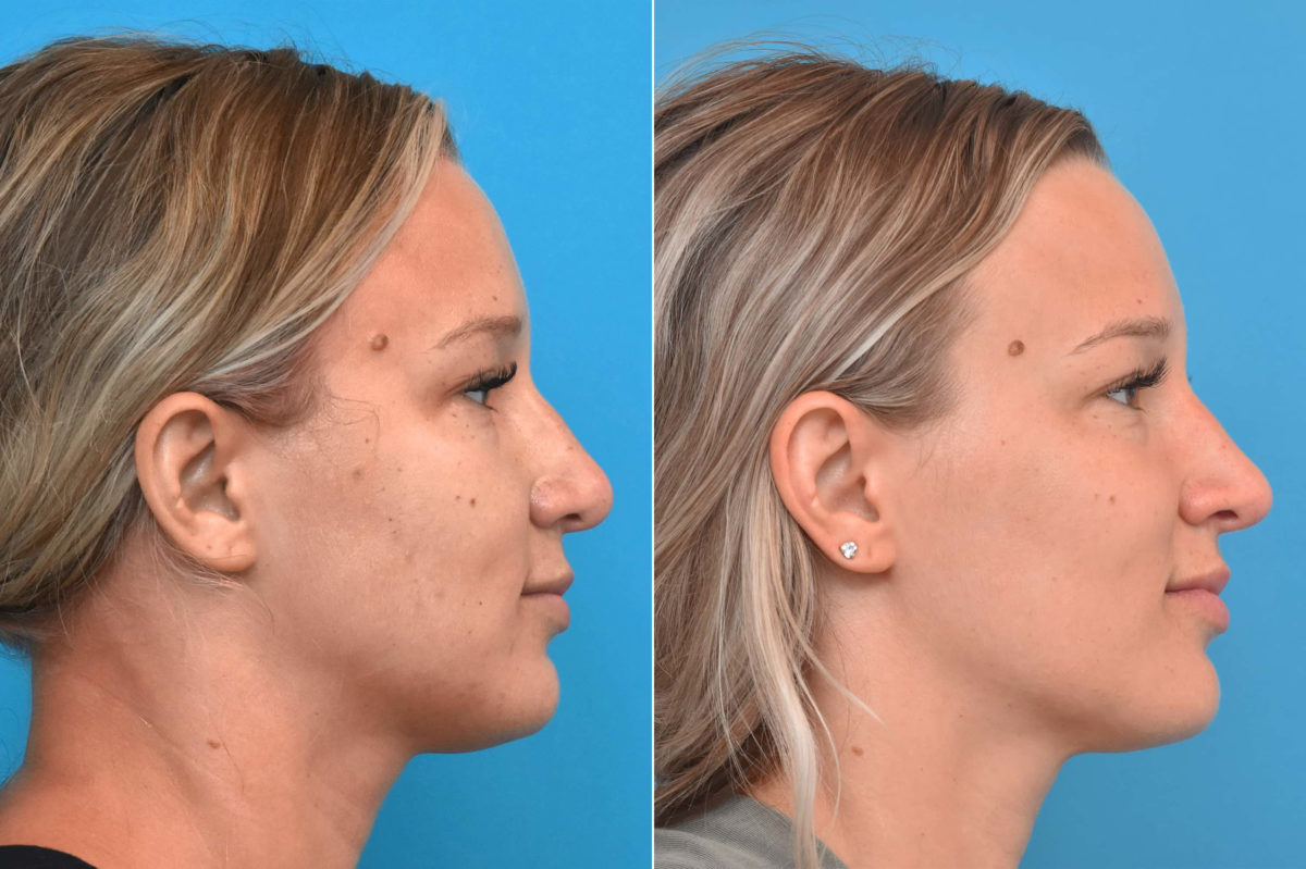 Rhinoplasty Before and After Photos in Philadelphia, PA, Patient 3767