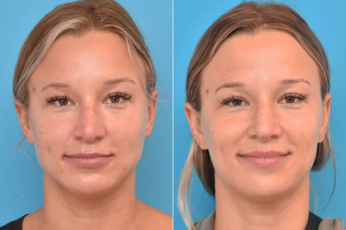 Rhinoplasty Before and After Photos in Philadelphia, PA, Patient 3767