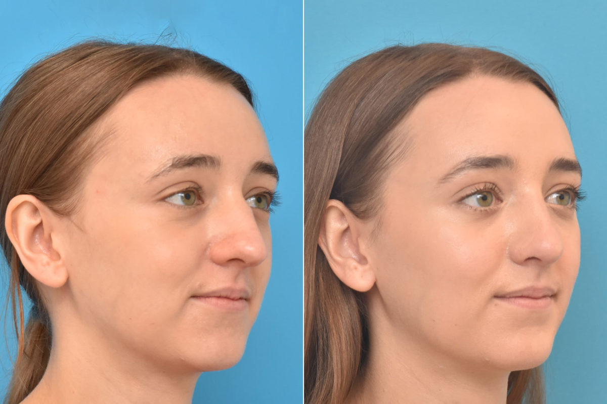 Rhinoplasty Before and After Photos in Philadelphia, PA, Patient 3768