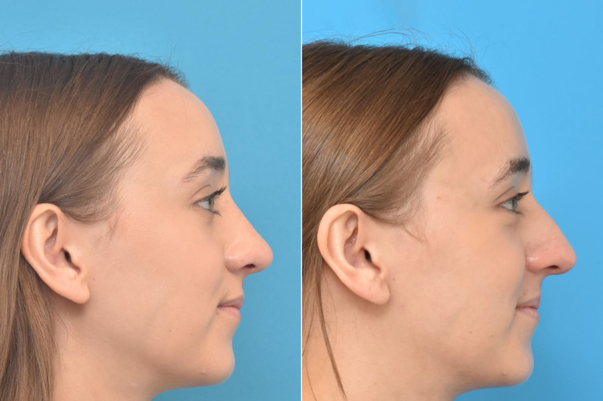 Rhinoplasty Before and After Photos in Philadelphia, PA, Patient 3768