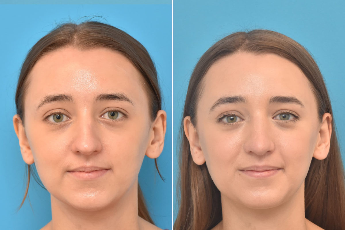 Rhinoplasty Before and After Photos in Philadelphia, PA, Patient 3768