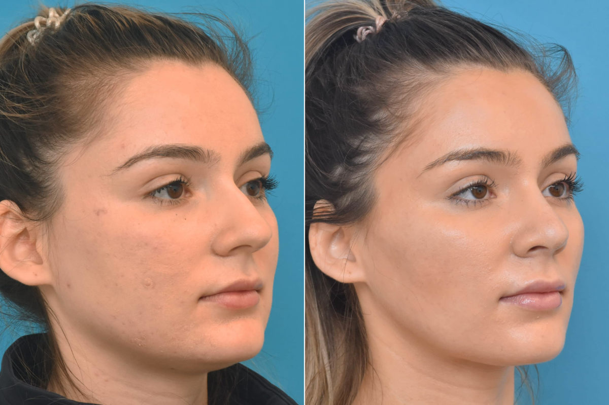 Rhinoplasty Before and After Photos in Philadelphia, PA, Patient 3769