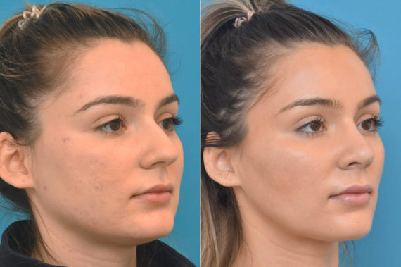 Rhinoplasty Before and After Photos in Philadelphia, PA, Patient 3769