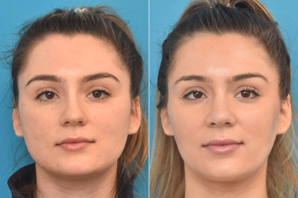 Rhinoplasty Before and After Photos in Philadelphia, PA, Patient 3769