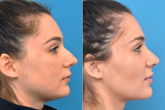 Rhinoplasty Before and After Photos in Philadelphia, PA, Patient 3769