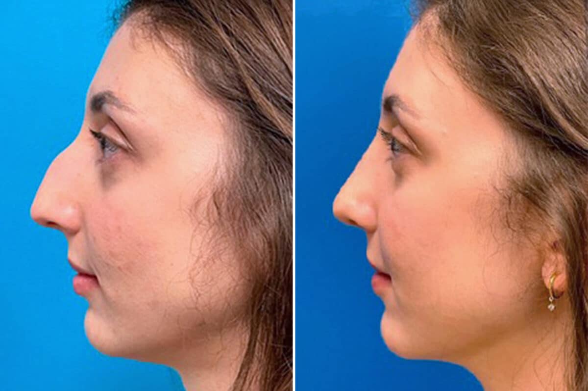 Twisted Nose Before and After Photos in Sewell, NJ, Patient 3852