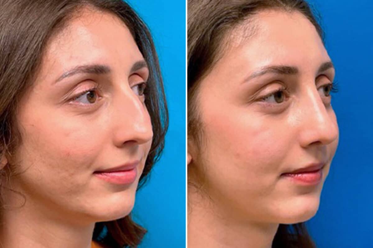 Twisted Nose Before and After Photos in Sewell, NJ, Patient 3852