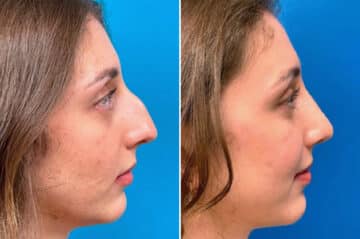 Twisted Nose Before and After Photos in Sewell, NJ, Patient 3852