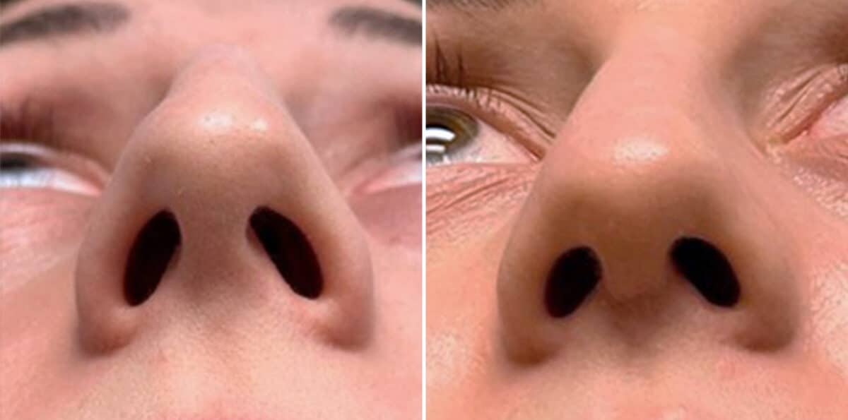 Twisted Nose Before and After Photos in Sewell, NJ, Patient 3852