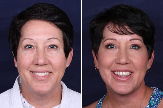 Facelift Before and After Photos in Voorhees Township, NJ, Patient 3946