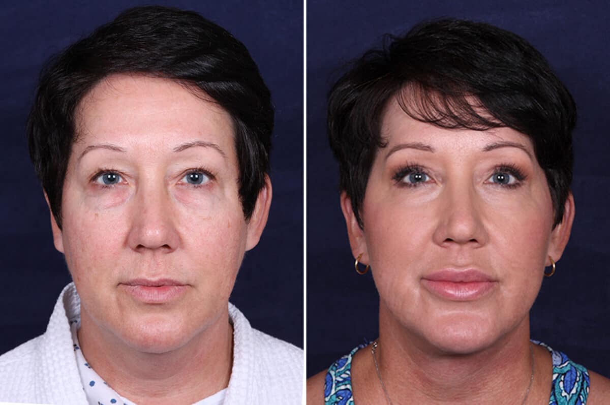 Facelift Before and After Photos in Voorhees Township, NJ, Patient 3946