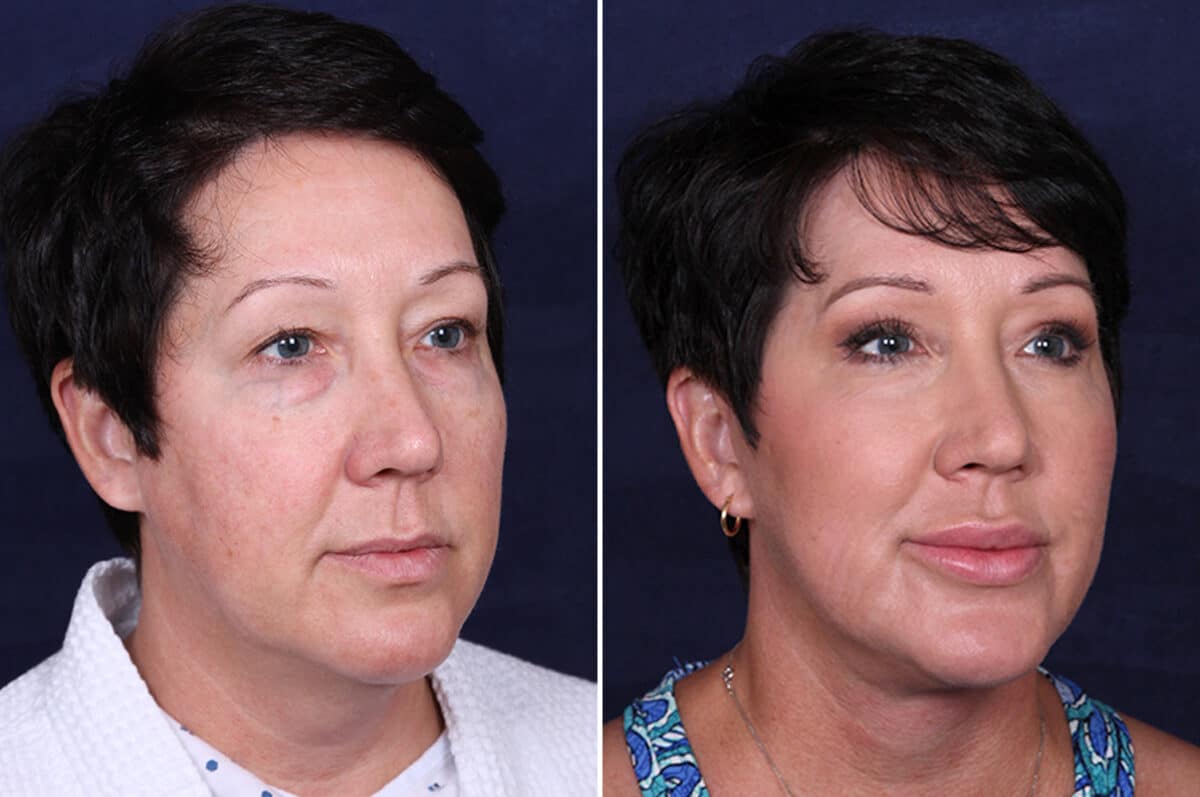 Facelift Before and After Photos in Voorhees Township, NJ, Patient 3946