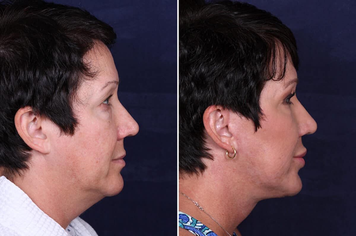 Facelift Before and After Photos in Voorhees Township, NJ, Patient 3946