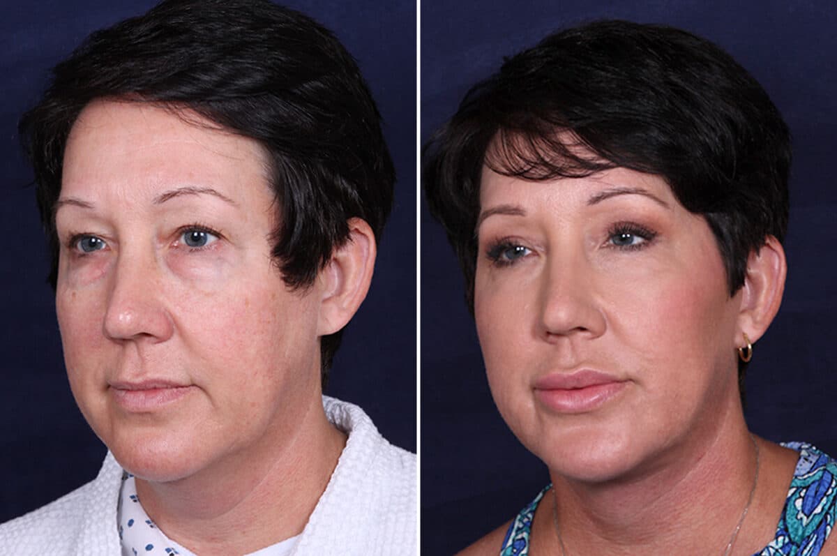 Facelift Before and After Photos in Voorhees Township, NJ, Patient 3946