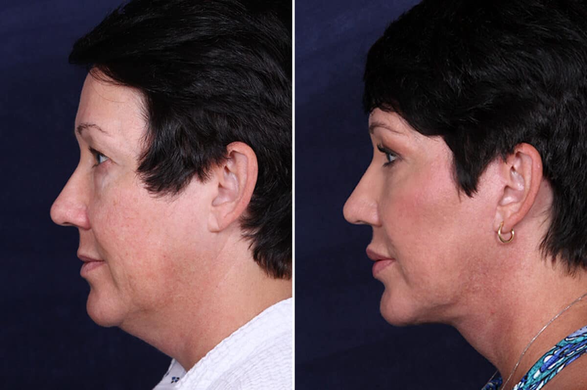 Facelift Before and After Photos in Voorhees Township, NJ, Patient 3946