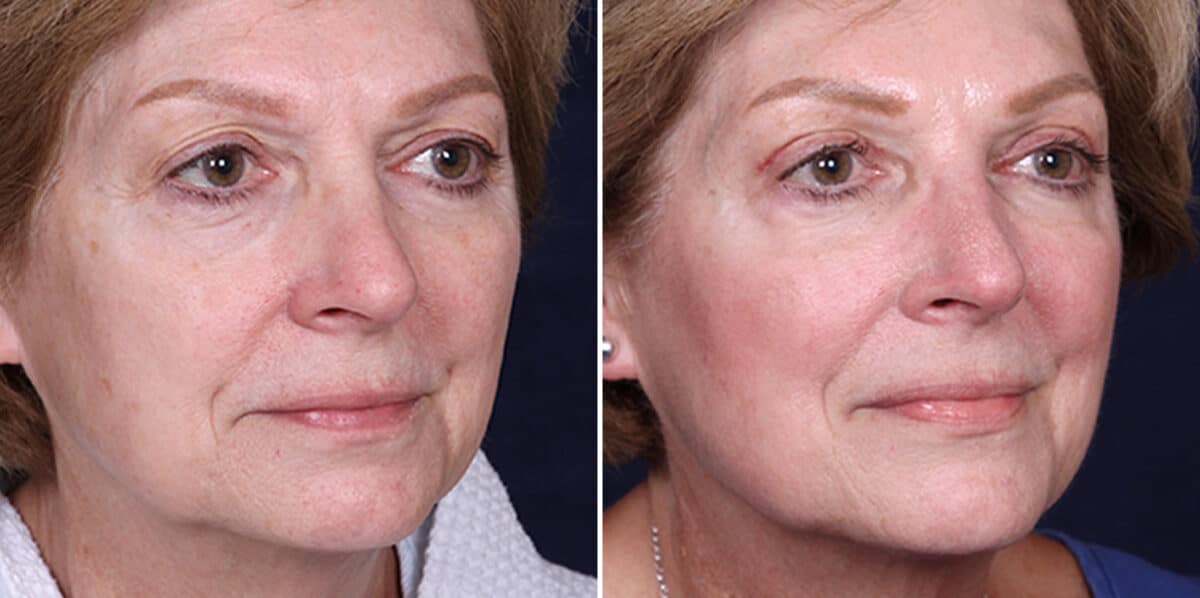 Upper Eyelid Surgery Before and After Photos in Voorhees Township, NJ, Patient 3965