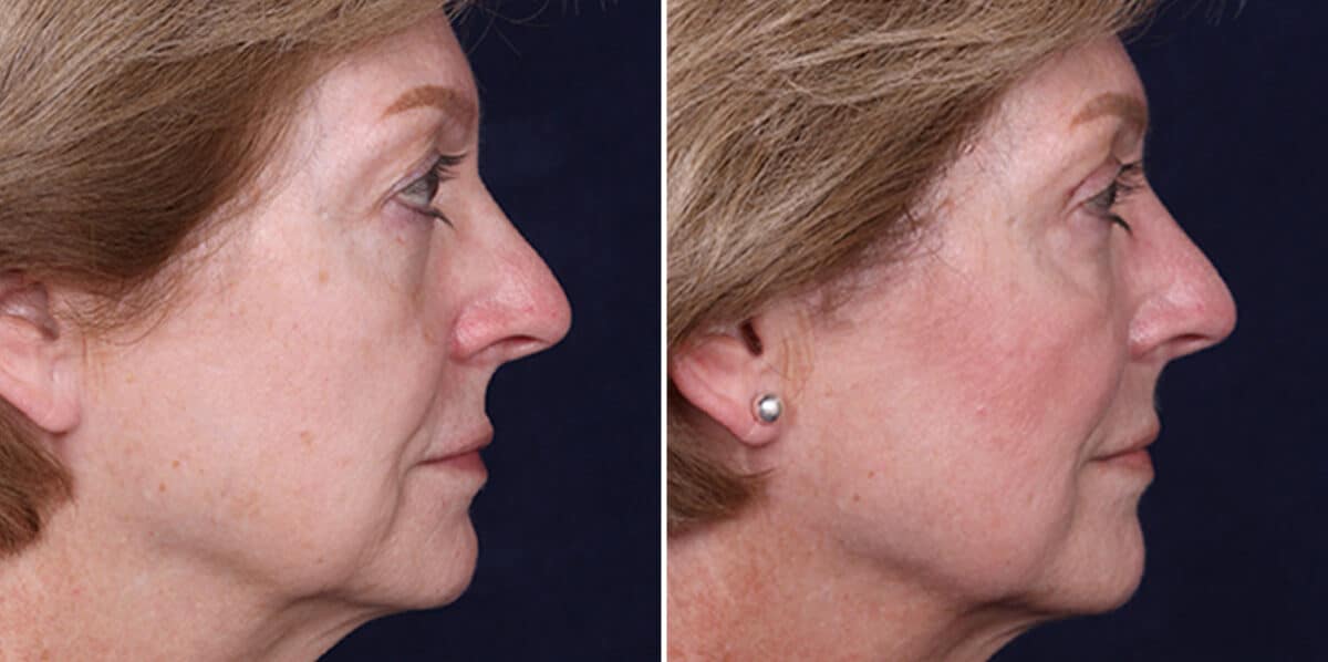 Upper Eyelid Surgery Before and After Photos in Voorhees Township, NJ, Patient 3965