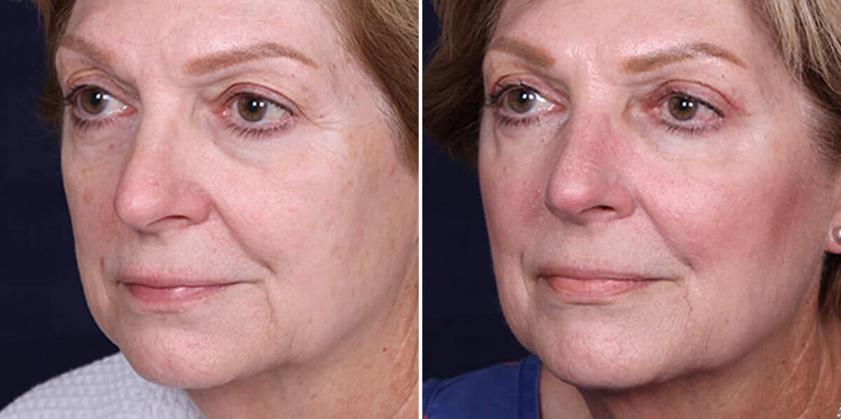 Upper Eyelid Surgery Before and After Photos in Voorhees Township, NJ, Patient 3965