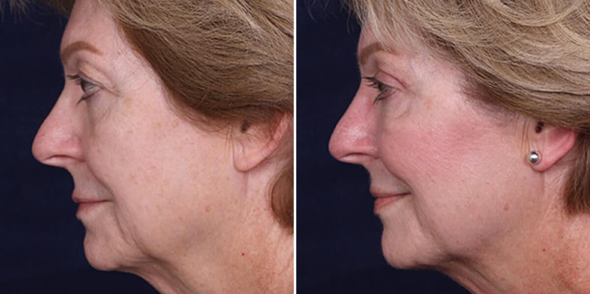 Upper Eyelid Surgery Before and After Photos in Voorhees Township, NJ, Patient 3965