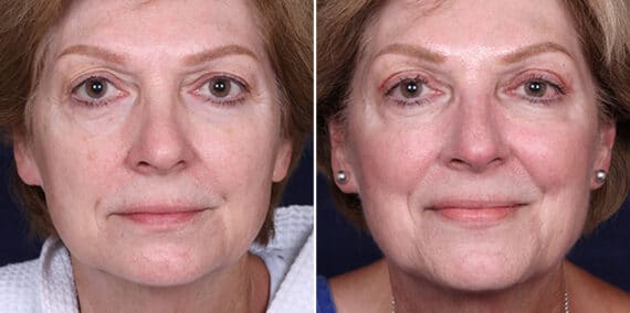 Upper Eyelid Surgery Before and After Photos in Voorhees Township, NJ, Patient 3965