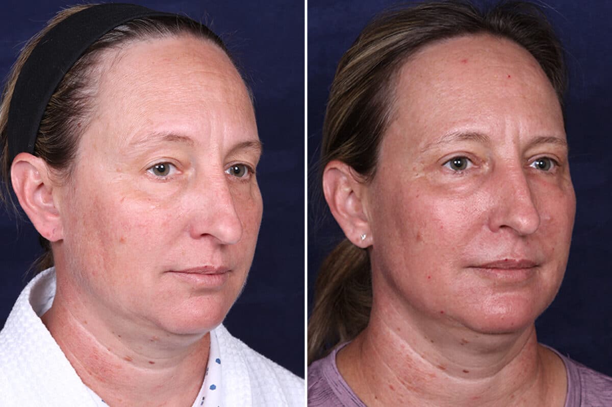 Laser Treatments Before and After Photos in Voorhees Township, NJ, Patient 3982