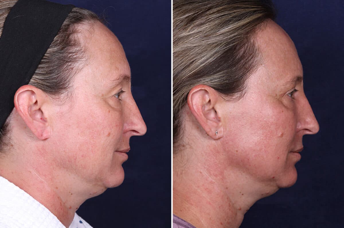 Laser Treatments Before and After Photos in Voorhees Township, NJ, Patient 3982