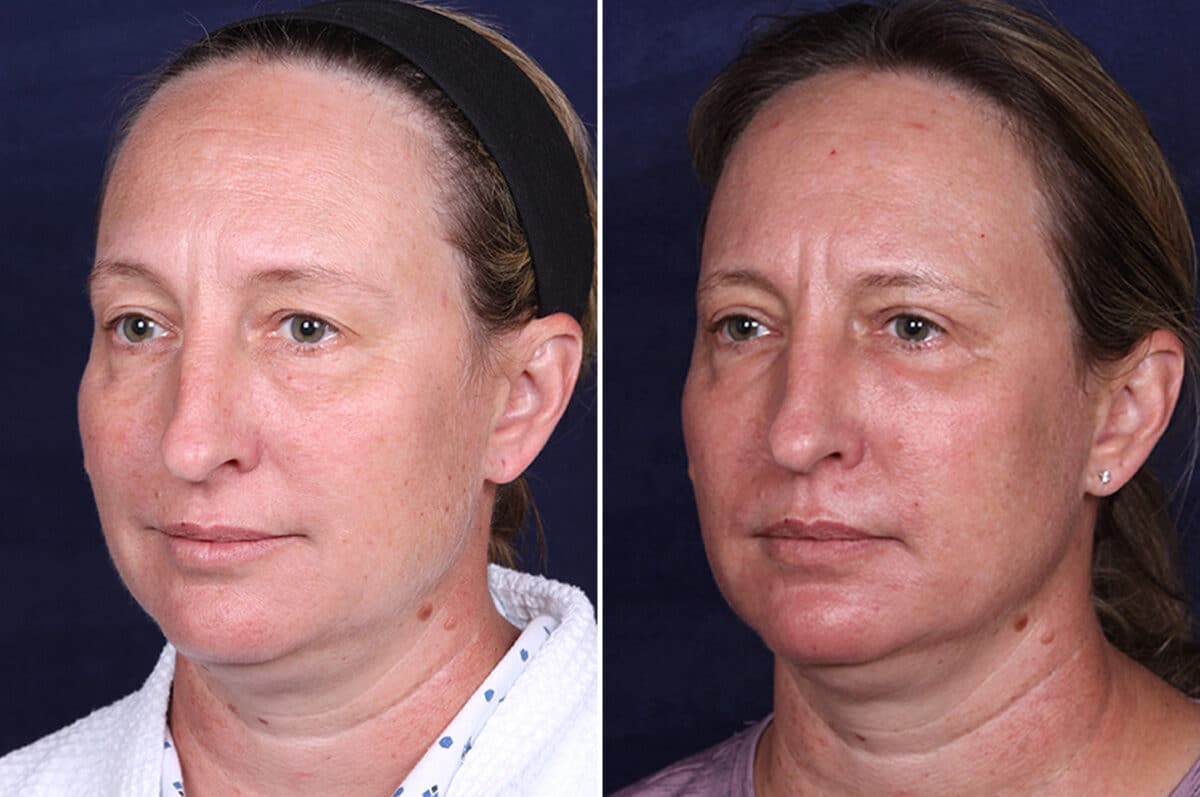 Laser Treatments Before and After Photos in Voorhees Township, NJ, Patient 3982